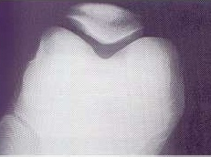 Tangential Patella Positioning